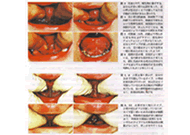 舌・上唇小帯切除術イメージ