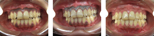 歯ぐきのクリーニングイメージ